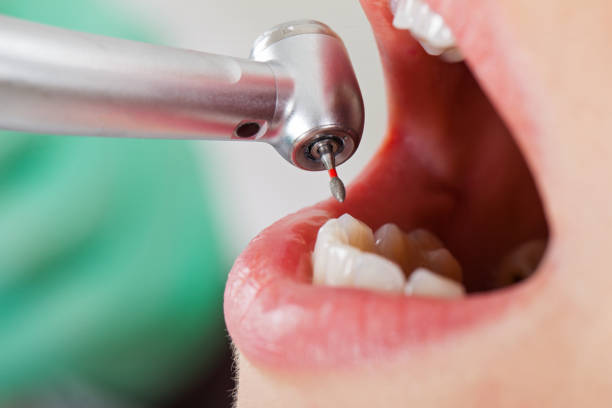 Best Emergency Tooth Extraction in Fairchild Af, WA
